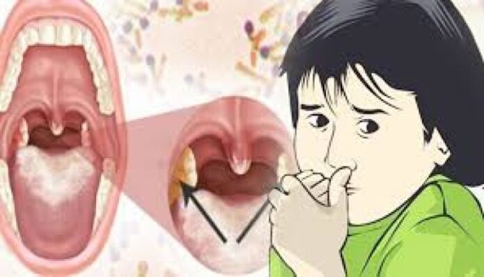 Dinkes - KB Mencatat Angka Penderita Difteri di Sampang Meningkat